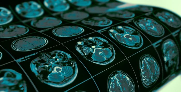 Researchers discover Toxoplasma gondii's mechanism of infecting brain cells